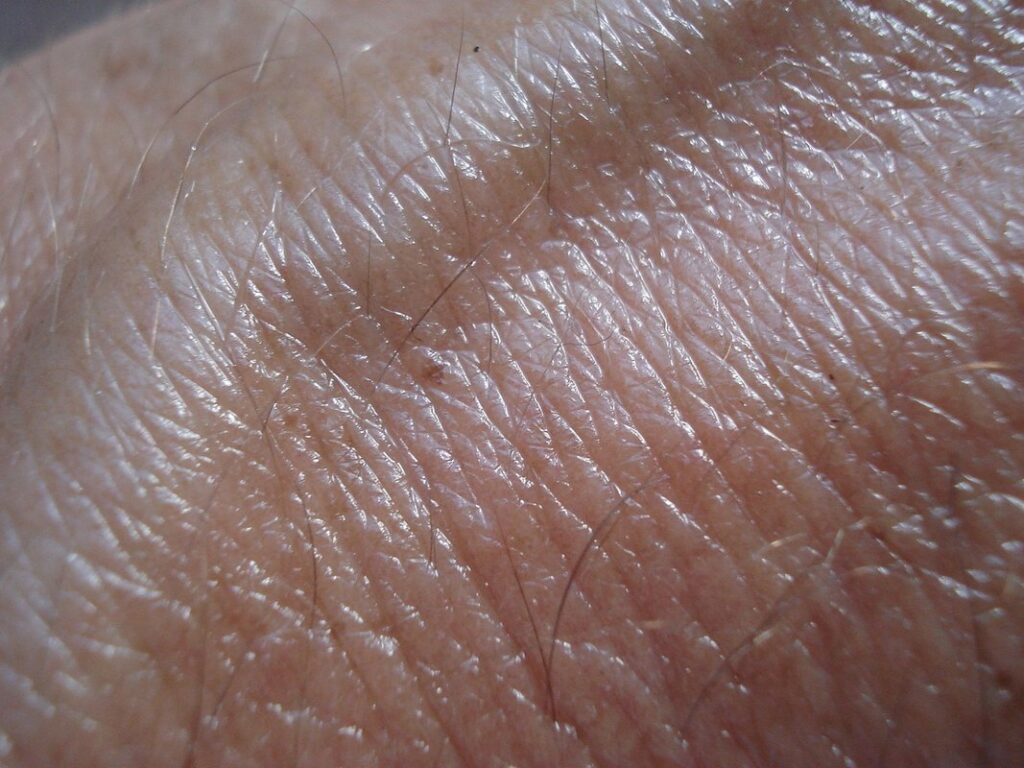 skin cancer in elderly