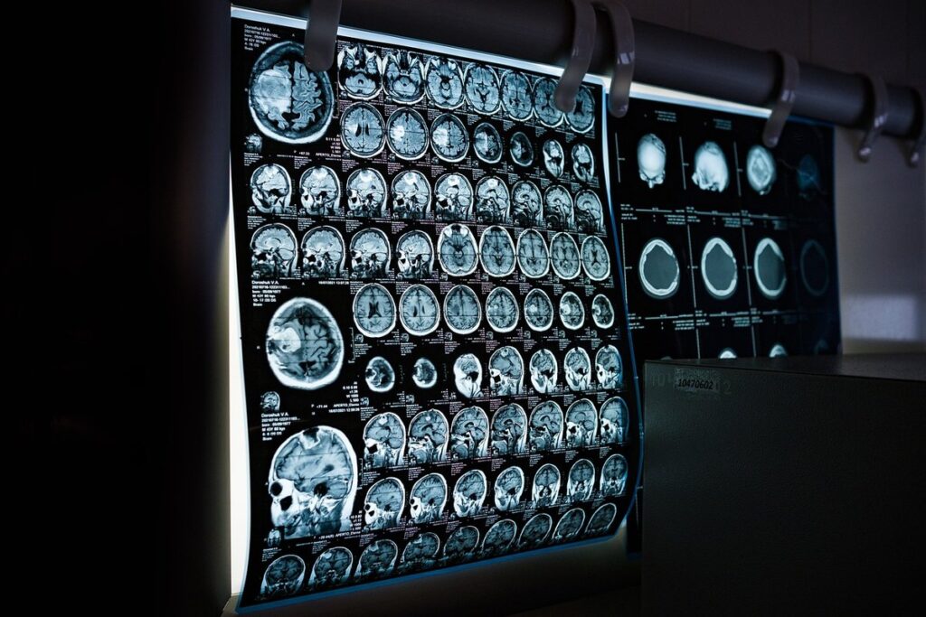 ct scan dementia diagnosis